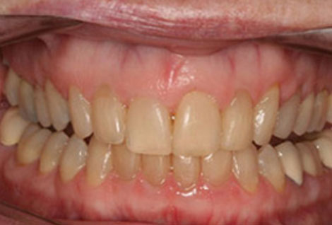 Before and after photo Orthodontics Case 02