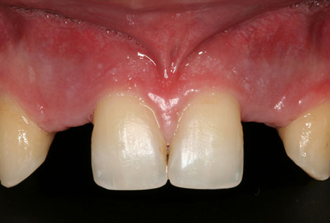 Dental Implants Before  Case 02