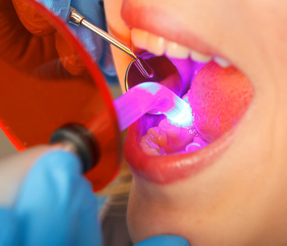 What is LANAP Laser Gum Surgery in Aliso Viejo CA Area