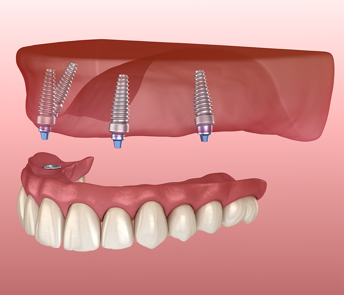 All on 4 Dental Implants Procedure in Aliso Viejo CA Area