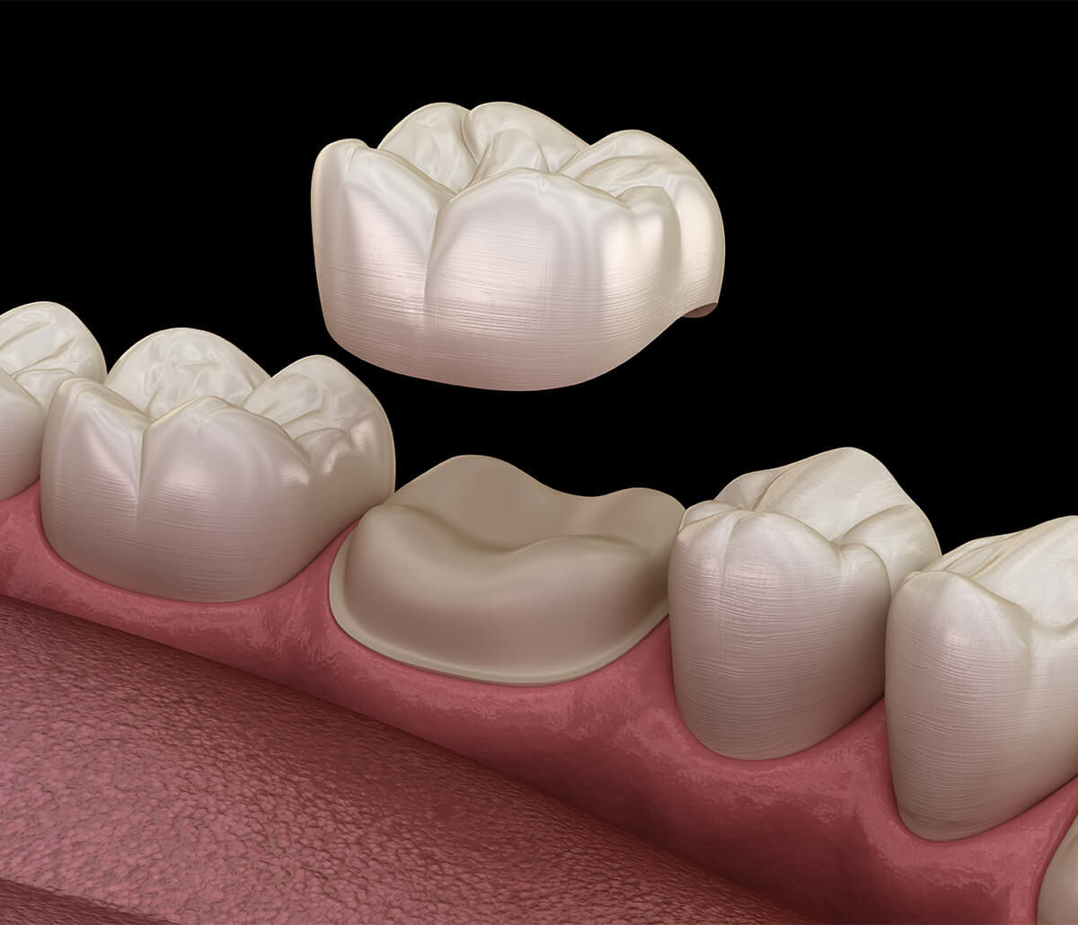 Same Day Dental Crowns Benefits in Aliso Viejo CA Area