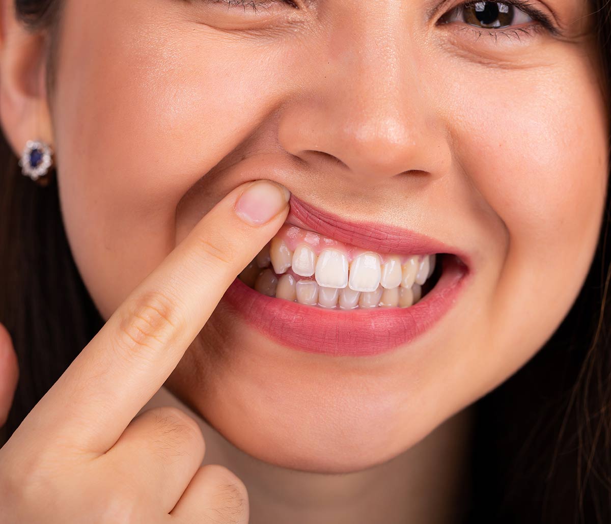 Don't Ignore Early Signs of Periodontal Disease in Aliso Viejo