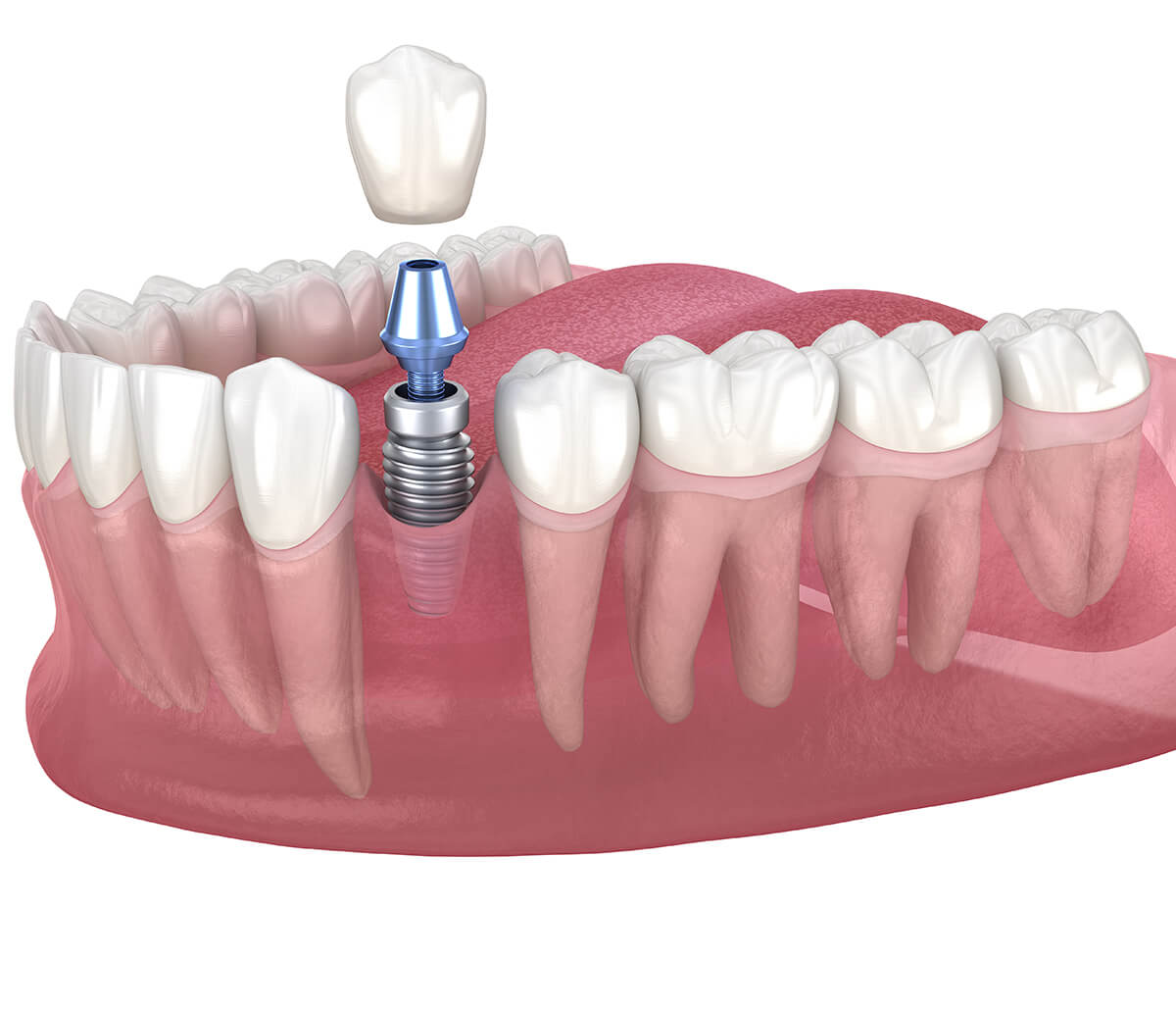 Looking for Dental Implants in Aliso Viejo CA Area